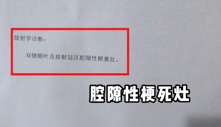 45歲三甲醫(yī)院腦梗專家自己腦梗了